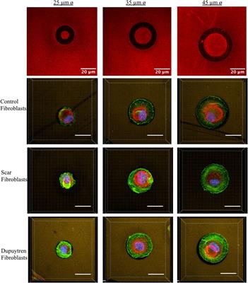 Rheological comparison between control and Dupuytren fibroblasts when plated in circular micropatterns using atomic force microscopy